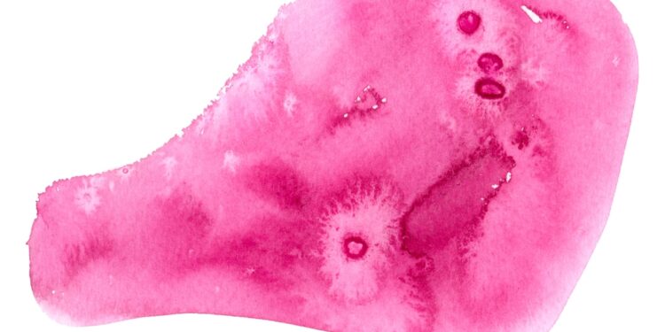 Papiliarinė fibroelastoma: simptomai, priežastys ir gydymas