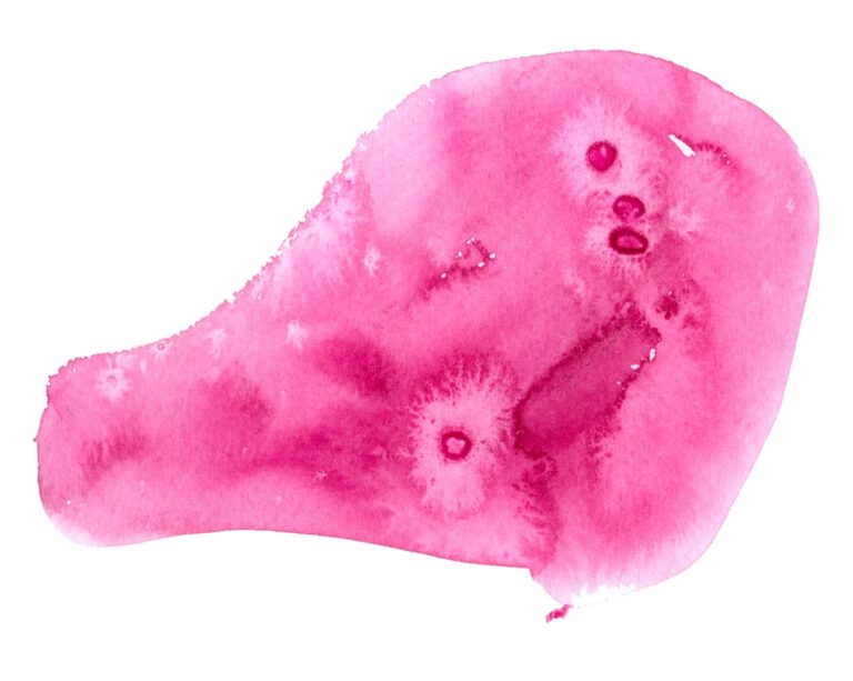 Papiliarinė fibroelastoma: simptomai, priežastys ir gydymas