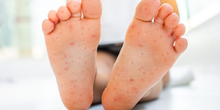 Rankų, pėdų ir burnos liga (RPBL): simptomai ir priežastys