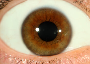 Permatomoji kraštinė degeneracija (PKD): simptomai ir gydymas