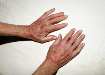 Holt-Oromo sindromas: simptomai, priežastys, diagnostika, gydymas ir prognozė