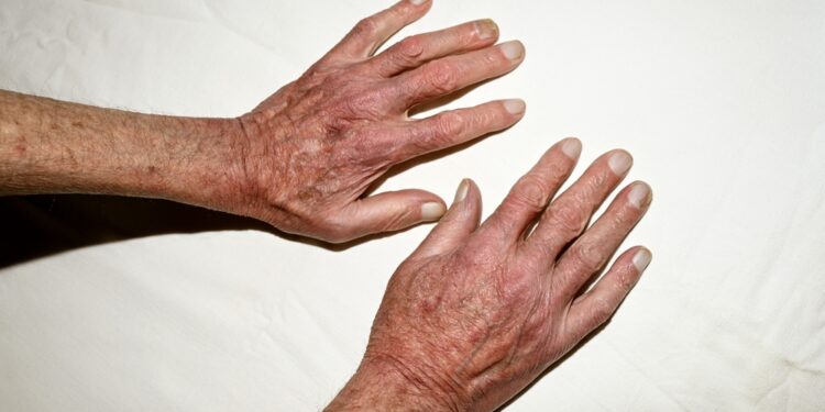 Holt-Oromo sindromas: simptomai, priežastys, diagnostika, gydymas ir prognozė