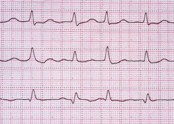 Idioventrikulinis ritmas: apibrėžimas, simptomai ir gydymas