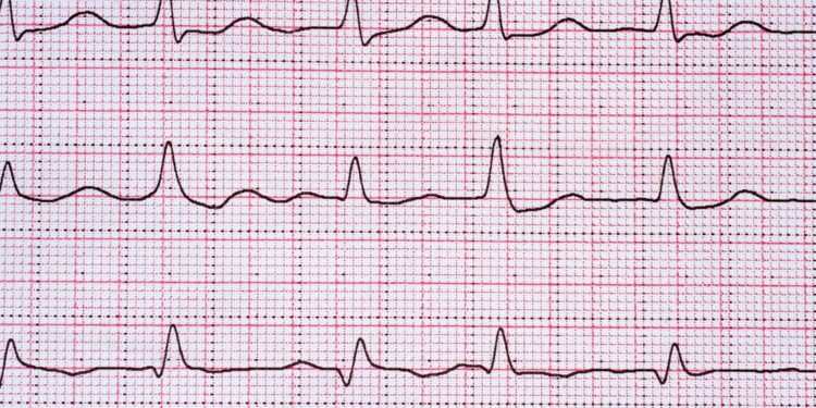 Idioventrikulinis ritmas: apibrėžimas, simptomai ir gydymas