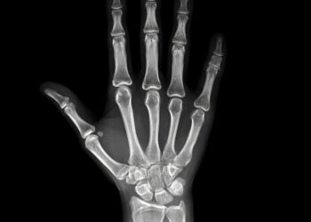 Osteopoikiliozė (OPK): simptomai, priežastys ir gydymas