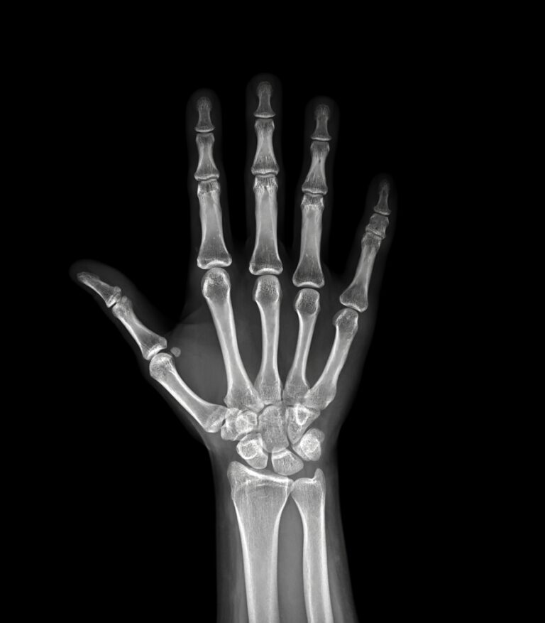 Osteopoikiliozė (OPK): simptomai, priežastys ir gydymas