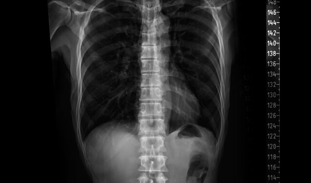 Mekonijaus ileusas: priežastys, diagnostika ir gydymas