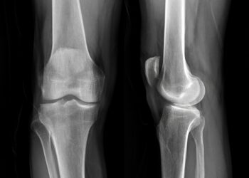 Osteitis fibrosa cystica: kas tai, simptomai ir gydymas
