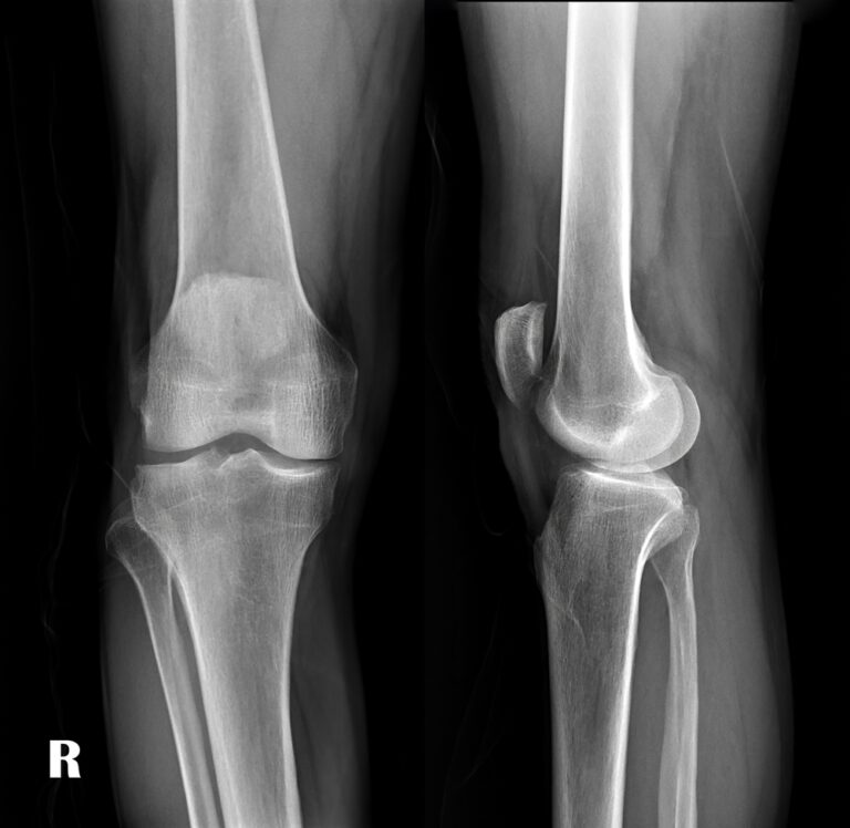 Osteitis fibrosa cystica: kas tai, simptomai ir gydymas
