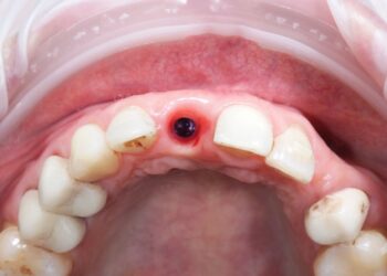 Švinavimas: priežastys, simptomai, tyrimai ir profilaktika