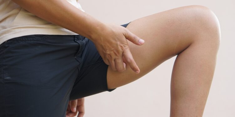 Kirkšnies niežulys: kas tai, simptomai ir gydymas