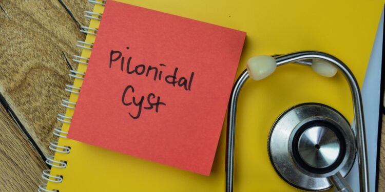 Pilonidinė cista: priežastys, simptomai, gydymas ir šalinimas