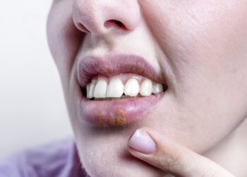 ŽPV burnoje: simptomai, gydymas ir gyvenimas su burnos ŽPV