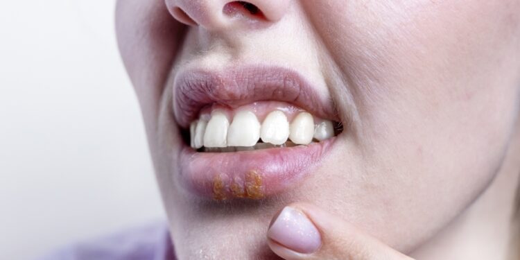 Žmogaus papilomos virusas burnoje