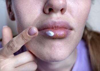 Orofacialinė granulomatozė: priežastys, simptomai ir gydymas