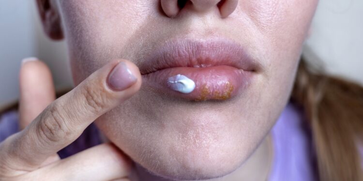 Orofacialinė granulomatozė: priežastys, simptomai ir gydymas