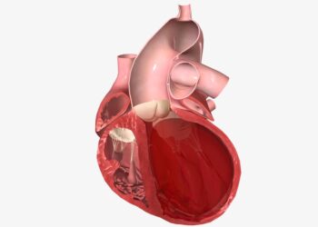 Atvira ovalioji anga (PFO): simptomai, priežastys ir gydymas