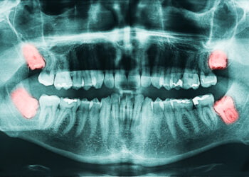Retinuoti protiniai dantys: simptomai, požymiai, šalinimas ir gijimas