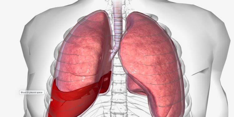 Hemopneumotoraksas: priežastys, simptomai ir gydymas