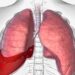 Hemopneumotoraksas: priežastys, simptomai ir gydymas