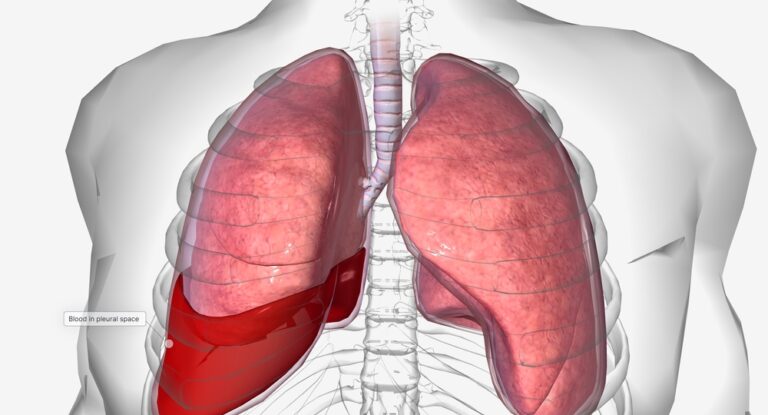 Hemopneumotoraksas: priežastys, simptomai ir gydymas