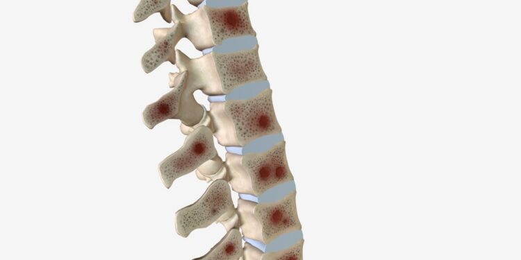 Marfano sindromas: simptomai, priežastys ir gydymas