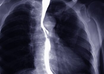 Stemplės plėvės: simptomai, priežastys ir gydymas