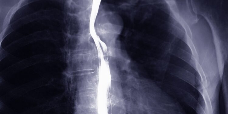Stemplės plėvės: simptomai, priežastys ir gydymas