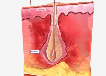 Ar hidradenitas (hidradenitis suppurativa) yra autoimuninė liga?