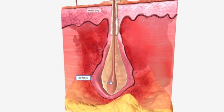 Ar hidradenitas (hidradenitis suppurativa) yra autoimuninė liga?