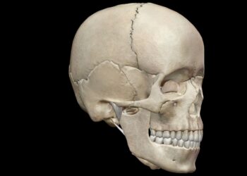 Metopinė kraniosinostozė: kas tai, simptomai ir gydymas