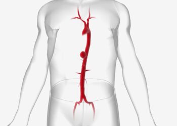 May-Thurner sindromas: priežastys, simptomai ir gydymas