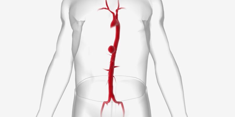 May-Thurner sindromas: priežastys, simptomai ir gydymas