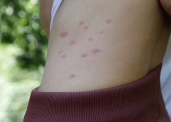 Greičiausias ir tinkamiausias šio pavadinimo vertimas būtų:„Atsakos į aklių įkandimus: gydymas ir nuotraukos“Arba neutraliau, priklausomai nuo konteksto:„Aklių įkandimų gydymas ir nuotraukos“Jei reikia labiau informacinio stiliaus:„Kaip gydyti aklių įkandimus (su nuotraukomis)“