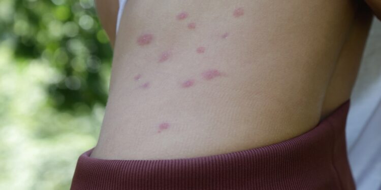 Greičiausias ir tinkamiausias šio pavadinimo vertimas būtų:„Atsakos į aklių įkandimus: gydymas ir nuotraukos“Arba neutraliau, priklausomai nuo konteksto:„Aklių įkandimų gydymas ir nuotraukos“Jei reikia labiau informacinio stiliaus:„Kaip gydyti aklių įkandimus (su nuotraukomis)“