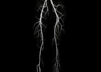 Kas yra šlauninės arterijos aneurizma?