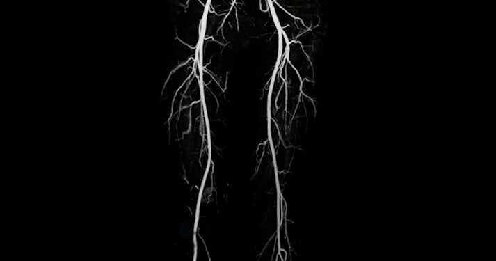 Kas yra šlauninės arterijos aneurizma?