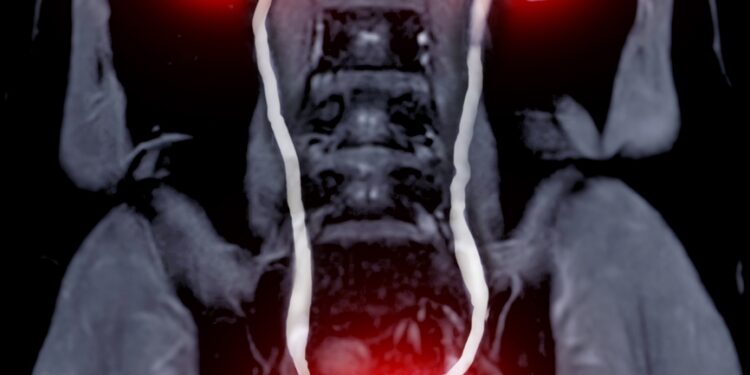 Inkstų vėžys: simptomai, požymiai, priežastys ir gydymas