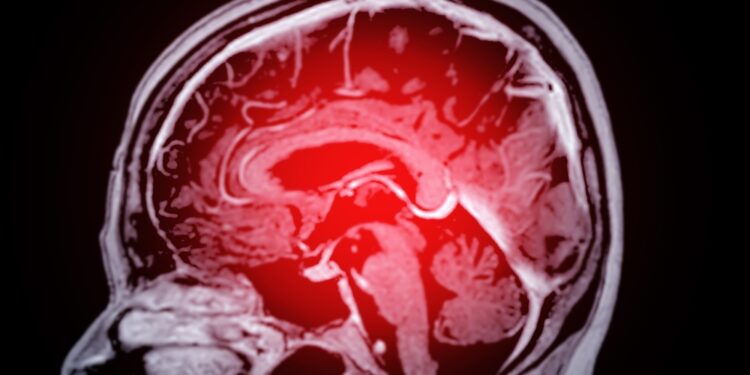 Kraujavimas į smegenis: kas tai, požymiai ir gydymas
