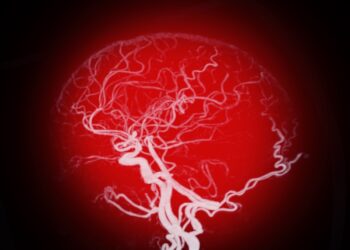 Vidurinės smegenų arterijos insultas: kas tai ir kokie simptomai