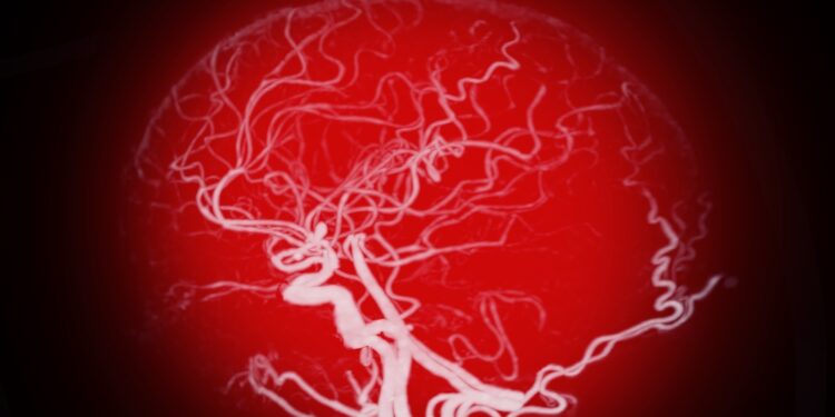 Vidurinės smegenų arterijos insultas: kas tai ir kokie simptomai