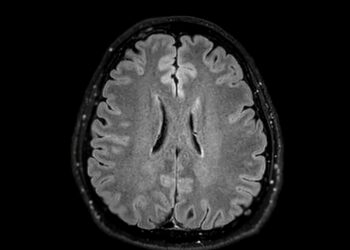 MELAS sindromas: kas tai, priežastys, simptomai ir gydymas