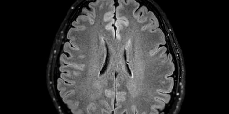 MELAS sindromas: kas tai, priežastys, simptomai ir gydymas