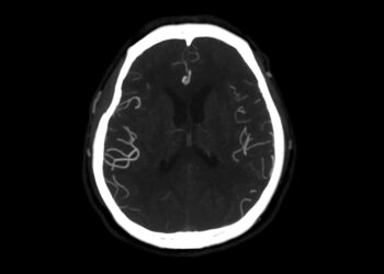 Hemihemigaliocefalija: priežastys, simptomai ir gydymas