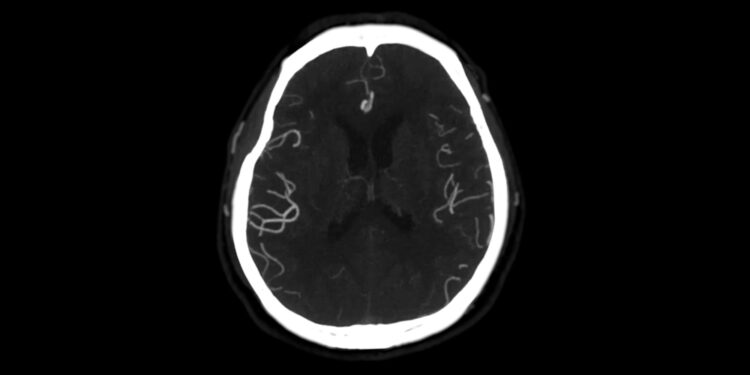 Hemihemigaliocefalija: priežastys, simptomai ir gydymas