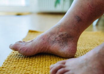 Haglundo deformacija: priežastys, simptomai ir gydymas