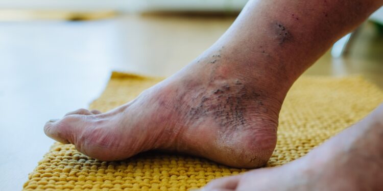 Haglundo deformacija: priežastys, simptomai ir gydymas