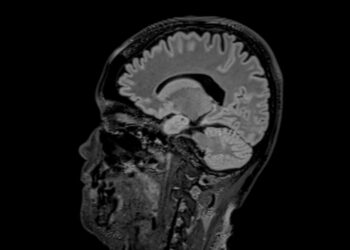 Kalmanno sindromas: simptomai, priežastys ir gydymas