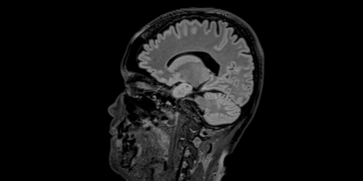 Kalmanno sindromas: simptomai, priežastys ir gydymas