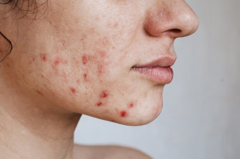 Hormoniniai spuogai: kas tai, priežastys, gydymas ir prevencija
